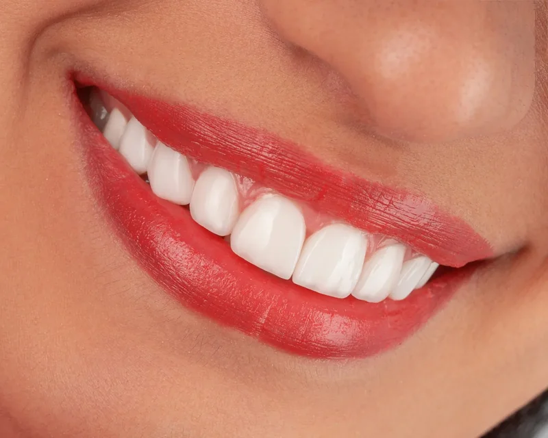 Résultat blanchiment dentaire sourire éclatant veneers - Centre Dentaire Benhayoune Tanger
