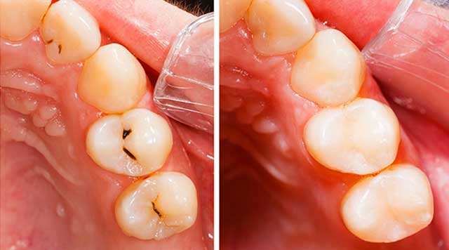 Odontologie conservatrice - Soins des caries Centre Dentaire Benhayoune Tanger