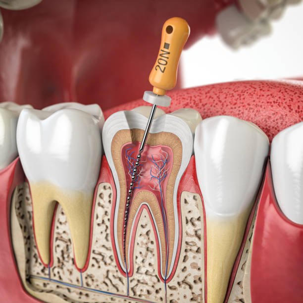 Endodontie (Traitement de Canal) - Centre Dentaire Benhayoune Tanger