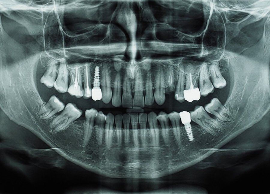 Radiographie dentaire numérique - Centre Dentaire Benhayoune Tanger
